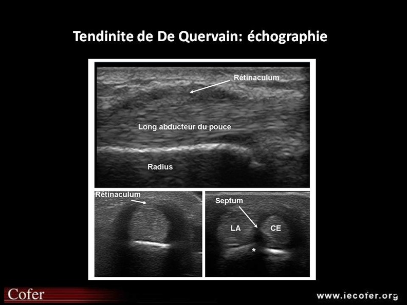 tendinite de De Quervain: échographie Epaississement typique du rétinaculum au dessus du long abducteur et du court extenseur du pouce en coupe longitudinale et transversale. Les 2 tendons peuvent parfois être séparés par un septum fibrocartilagineux qui prend naissance au niveau d’un spicule osseux, visible sur la coupe transversale (*). tendinite De Quervain -le goff- sep2015.jpg